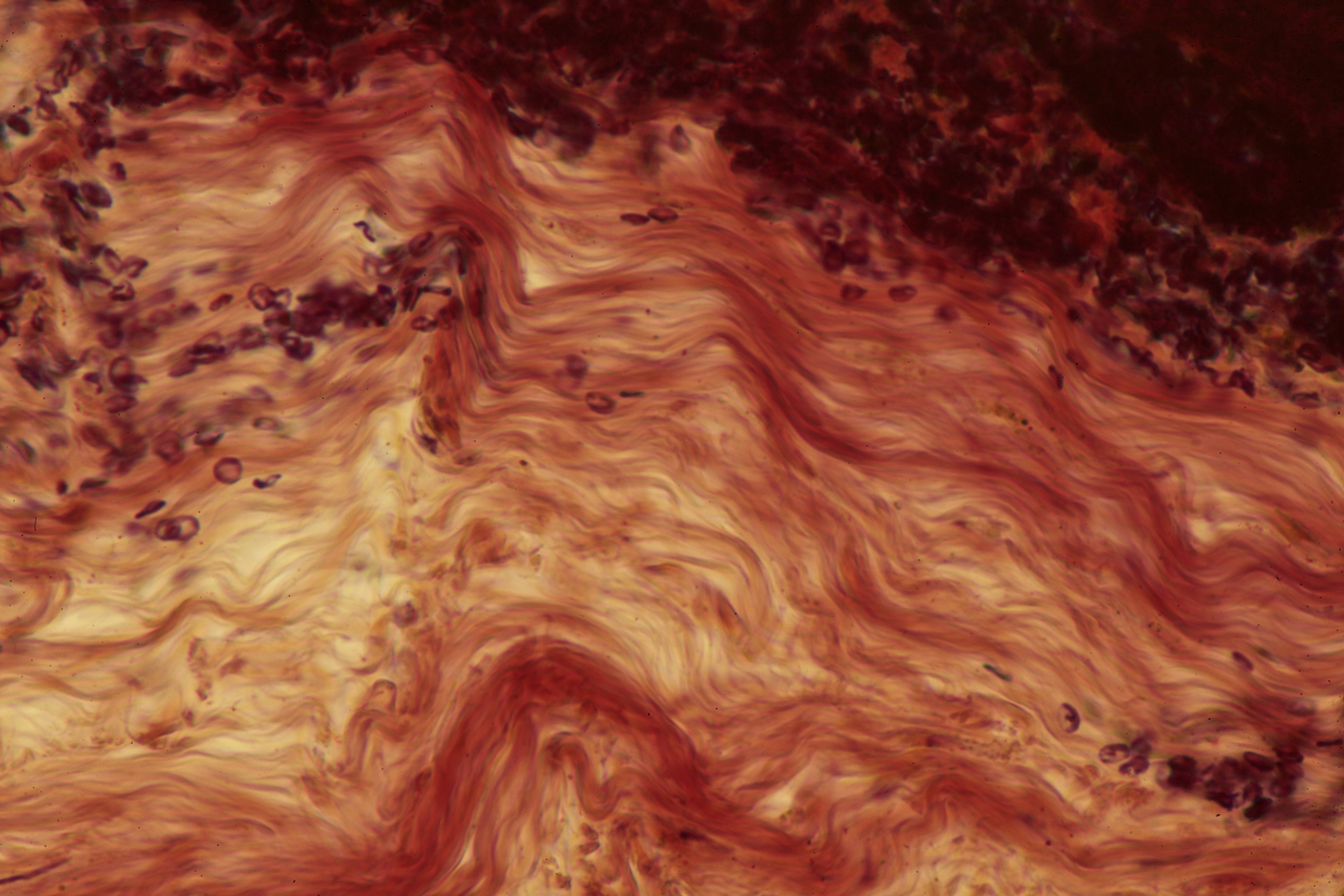 Internal Capsule Lesion