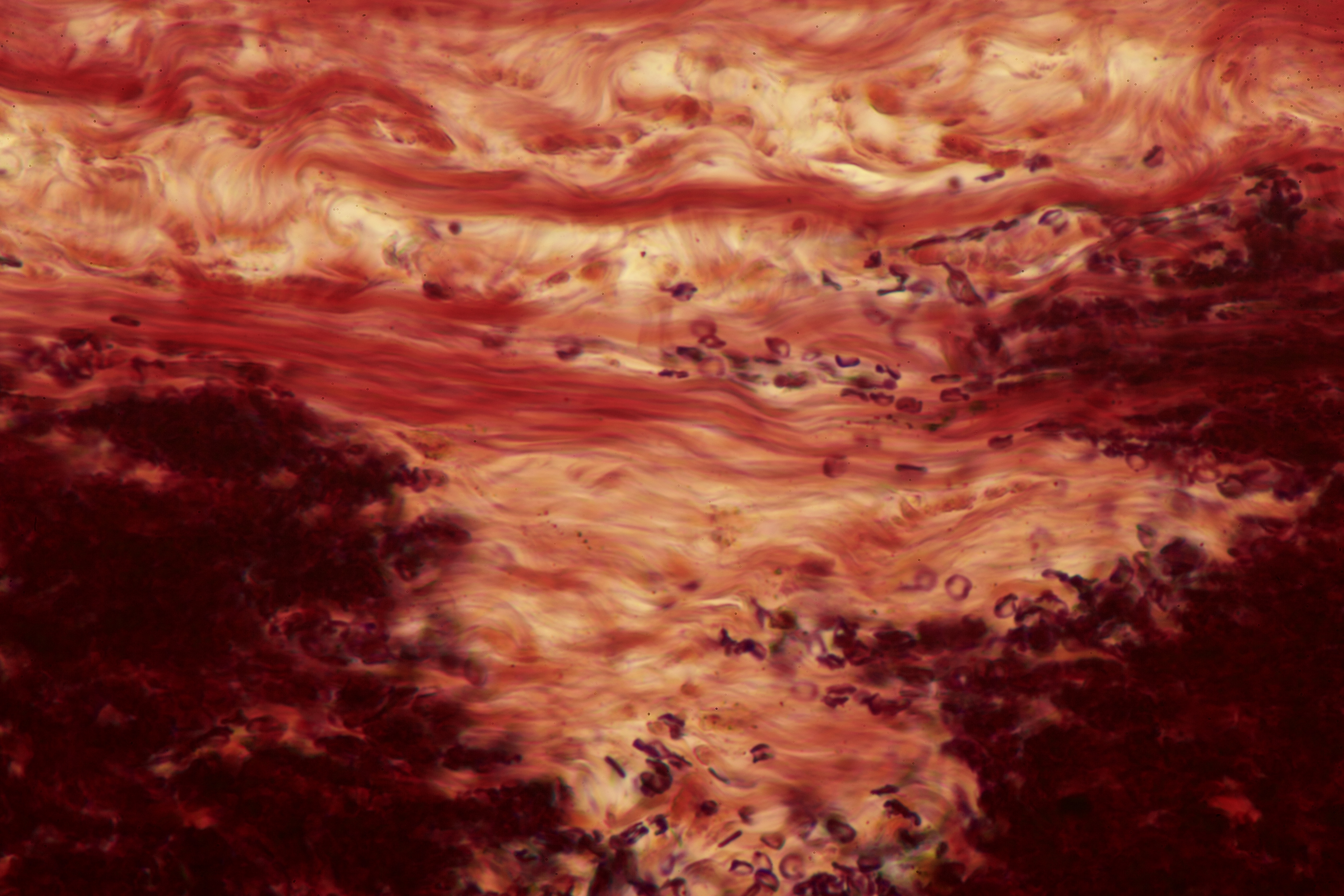Internal Capsule Lesion
