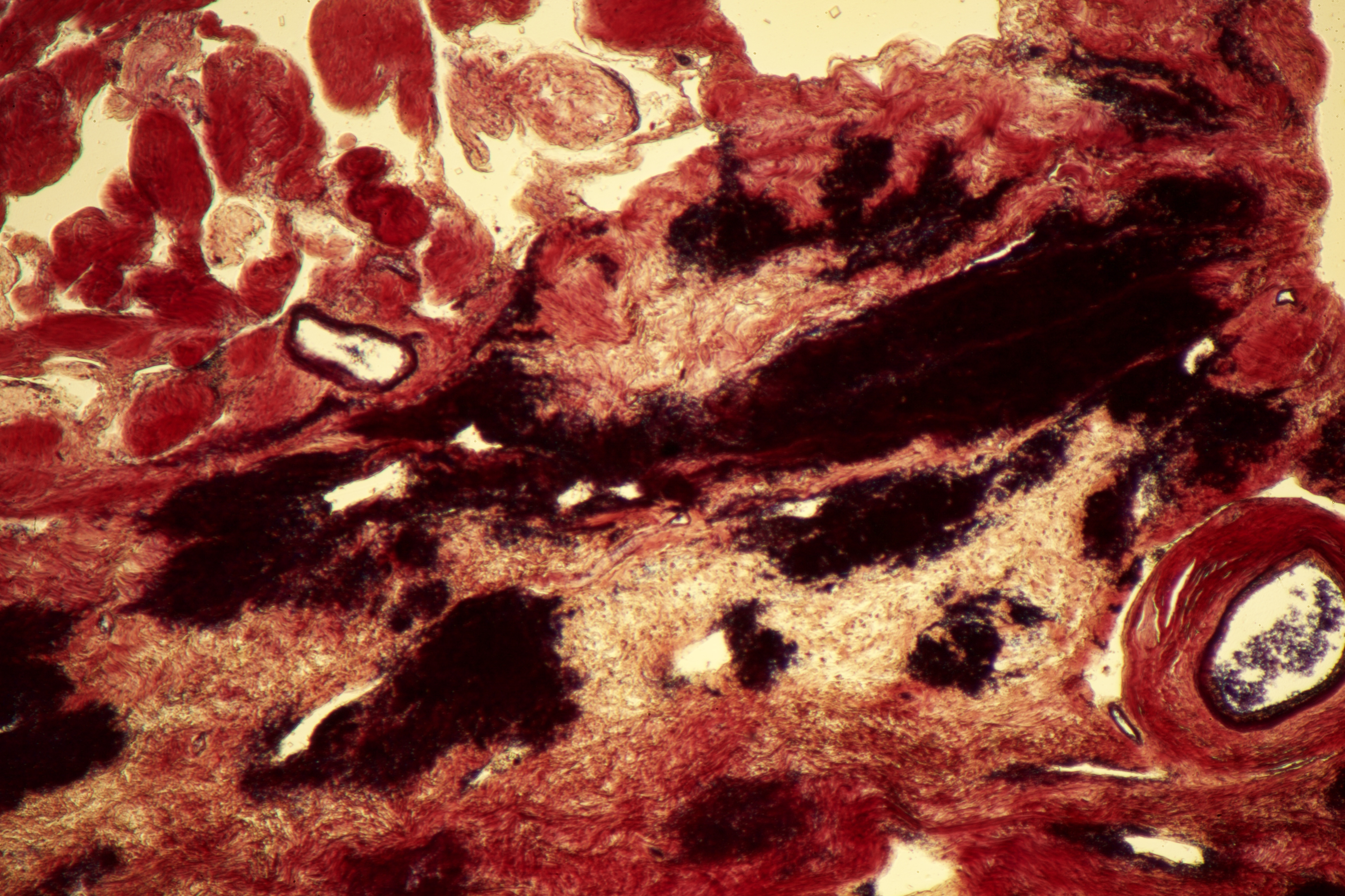 Internal Capsule Lesion